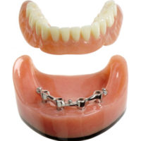 prothèses dentaires sur implants